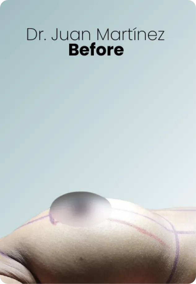 Breast Lift Augmentation Procedure Surgeon Queen Catalina Img3