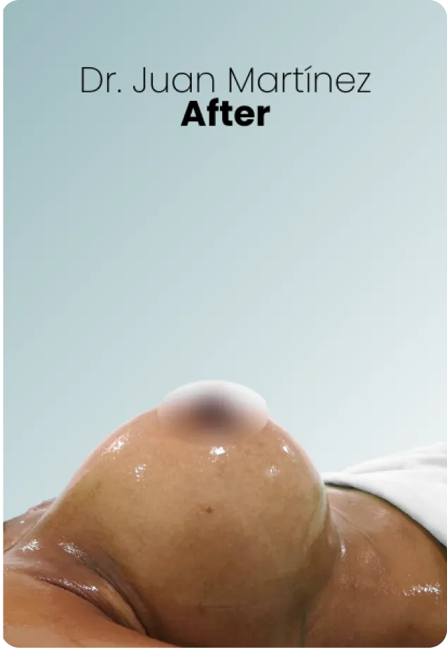 Breast Lift Augmentation Procedure Surgeon Queen Catalina Img4