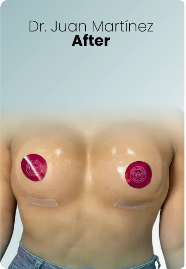 Breast Lift Augmentation Procedure Surgeon Queen Catalina Img5