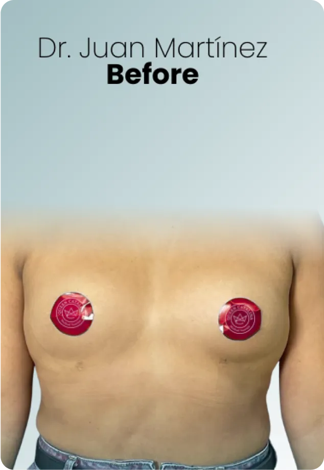 Breast Lift Augmentation Procedure Surgeon Queen Catalina Img6