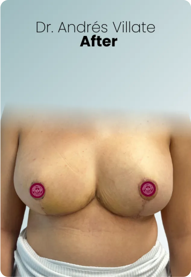Breast Lift Procedure Surgeon Queen Catalina Img4