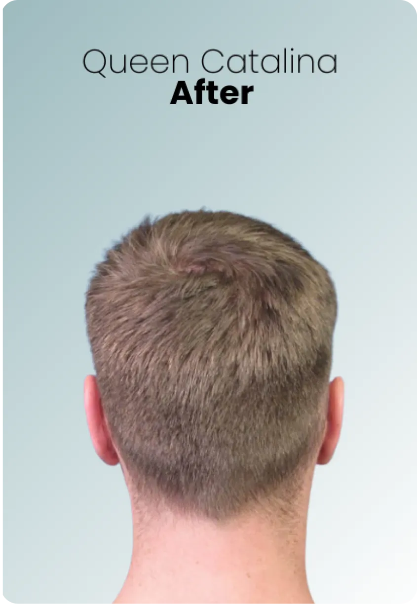 Ear Surgery Procedure Img1 Queen Catalina