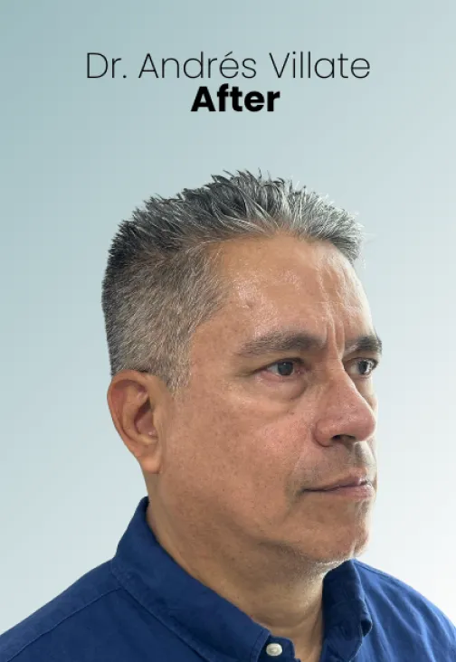 Face Lift Procedure Img1 Queen Catalina