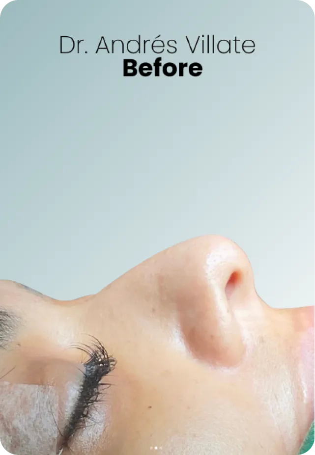 Rhinoplasty Porcedure Queen Catalina 1