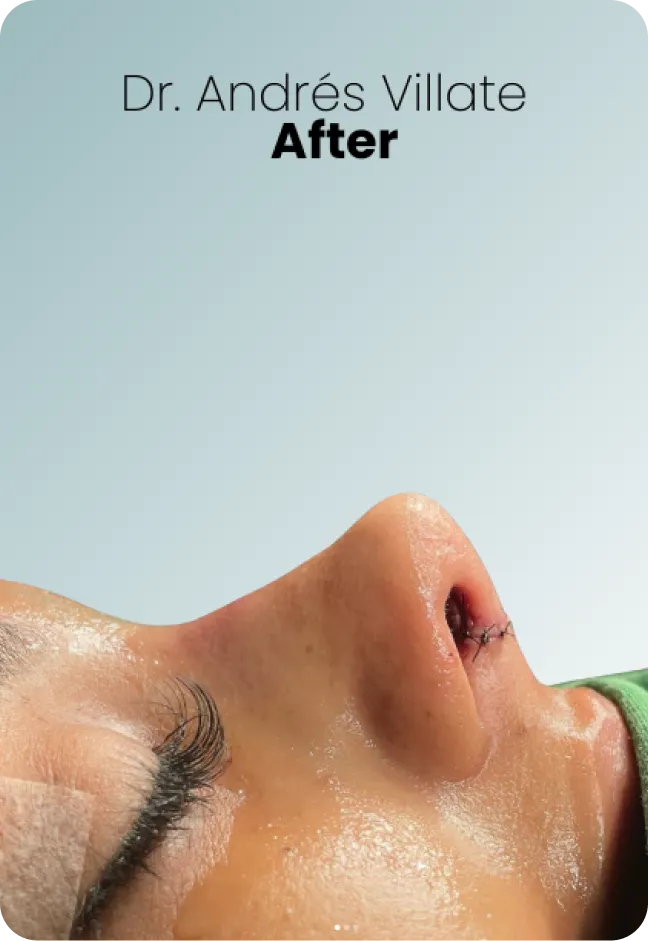 Rhinoplasty Porcedure Queen Catalina 2