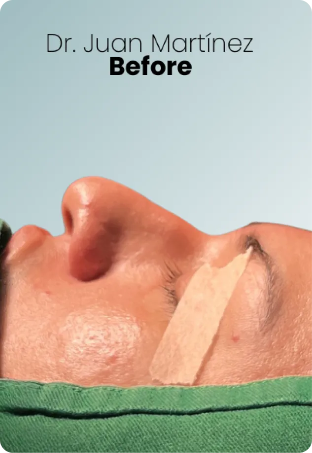 Rhinoplasty Procedure Img2 Queen Catalina