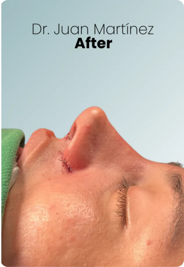 Rhinoplasty Procedure Img3 Queen Catalina