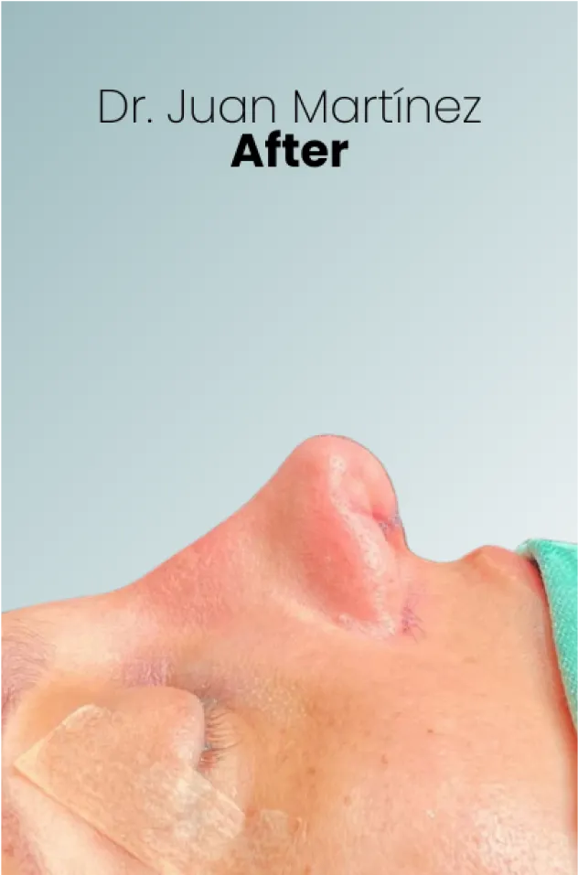 Rhinoplasty Procedure Img4 Queen Catalina