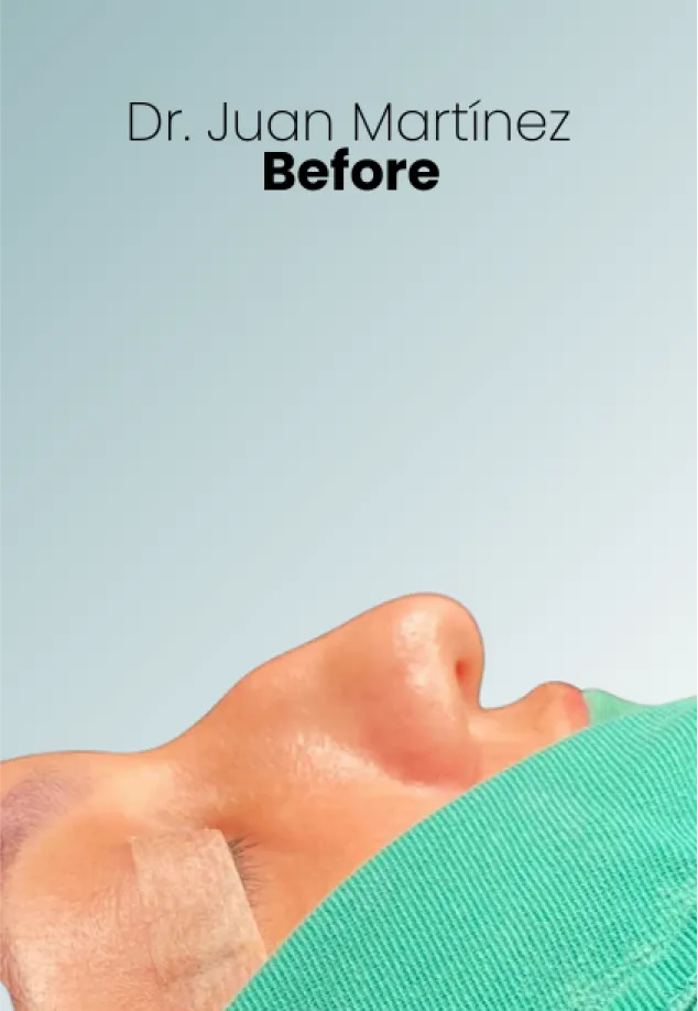 Rhinoplasty Procedure Img5 Queen Catalina