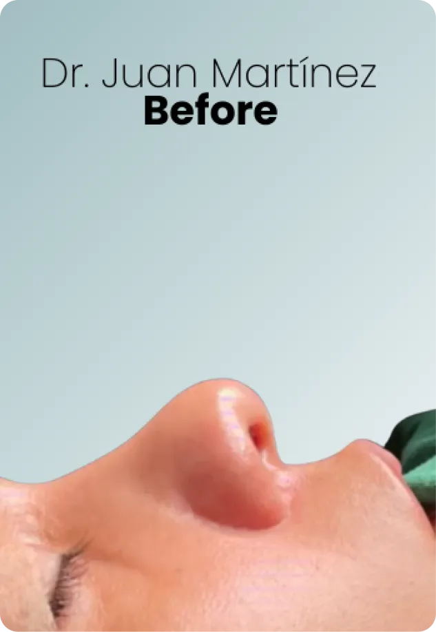 Rhinoplasty Procedure Img7 Queen Catalina