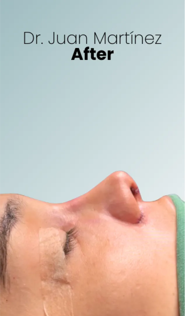 Rhinoplasty Procedure Img8 Queen Catalina