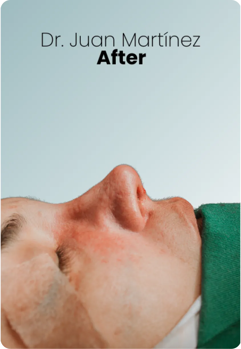 Rhinoplasty Queen Catalina Img