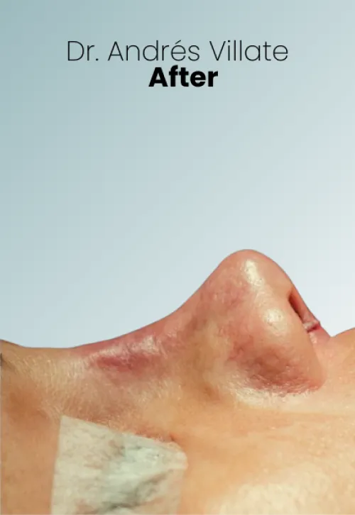 Surgeon Biography Andres Villate Procedure Img3 Queen Catalina