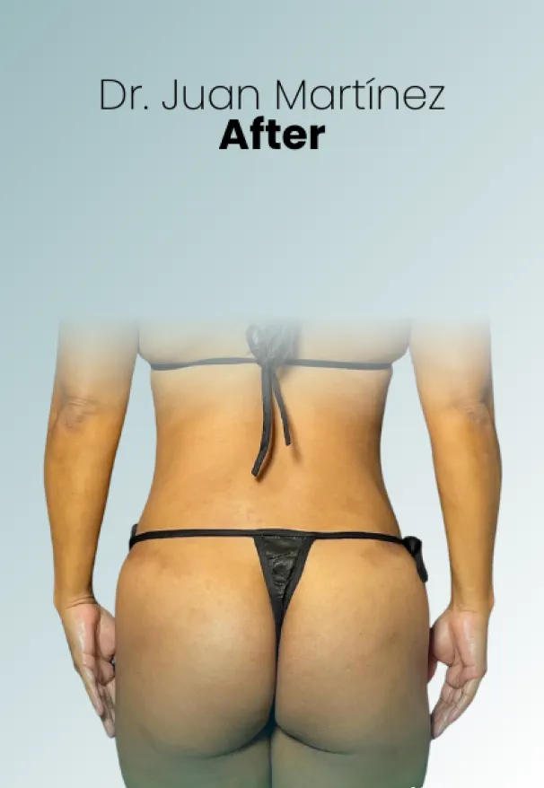 Surgeon Biography Juan Martinez Procedure Img110 Queen Catalina