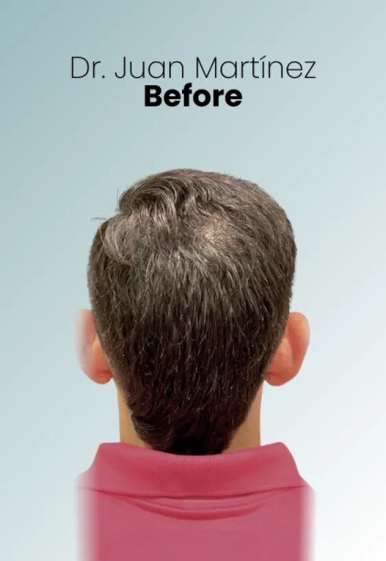 Surgeon Biography Juan Martinez Procedure Img24 Queen Catalina