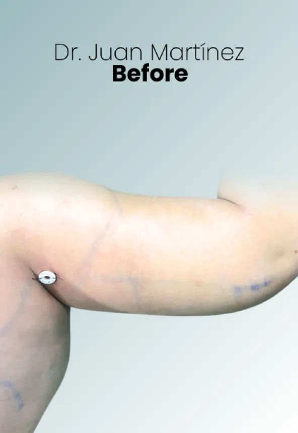 Surgeon Biography Juan Martinez Procedure Img34 Queen Catalina