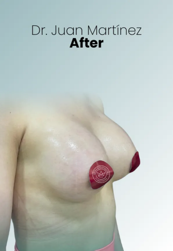 Surgeon Biography Juan Martinez Procedure Img41 Queen Catalina