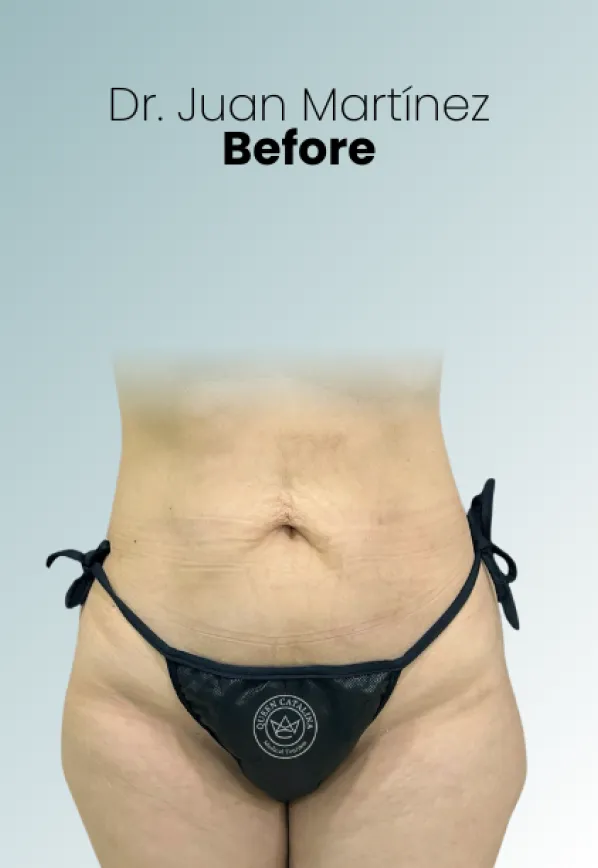 Surgeon Biography Juan Martinez Procedure Img70 Queen Catalina