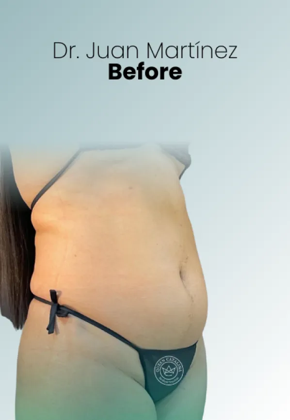 Surgeon Biography Juan Martinez Procedure Img74 Queen Catalina