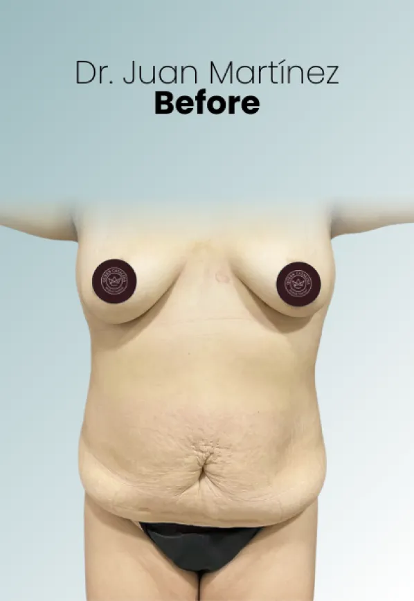 Surgeon Biography Juan Martinez Procedure Img79 Queen Catalina