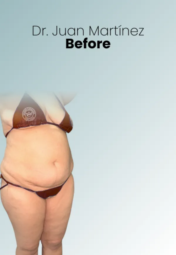 Surgeon Biography Juan Martinez Procedure Img85 Queen Catalina