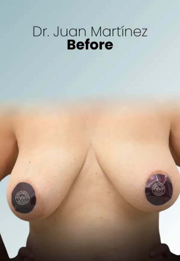 Surgeon Biography Juan Martinez Procedure Img87 Queen Catalina