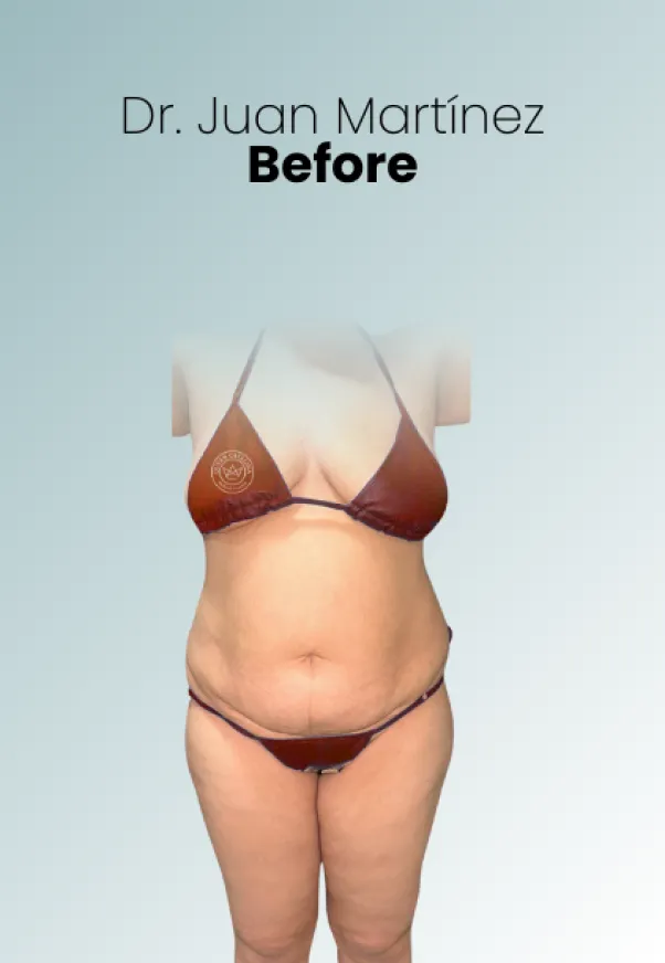 Surgeon Biography Juan Martinez Procedure Img91 Queen Catalina