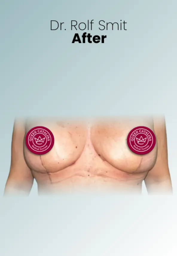 Surgeon Biography Rolf Smit Procedure Img1 Queen Catalina