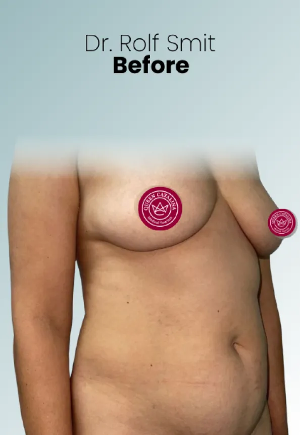 Surgeon Biography Rolf Smit Procedure Img22 Queen Catalina