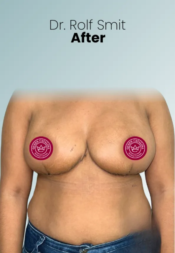 Surgeon Biography Rolf Smit Procedure Img23 Queen Catalina
