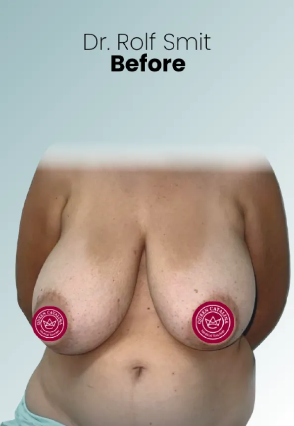 Surgeon Biography Rolf Smit Procedure Img26 Queen Catalina